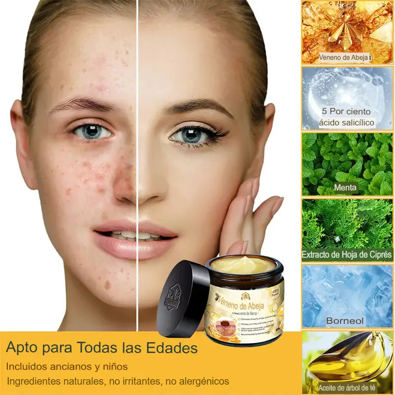 VENENO DE ABEJA - CREMA PARA EL TRATAMIENTO DE VERRUGAS, LUNARES, CICATRICES O IMPERFECCIONES