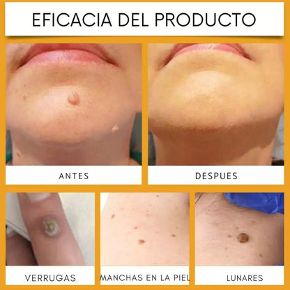 VENENO DE ABEJA - CREMA PARA EL TRATAMIENTO DE VERRUGAS, LUNARES, CICATRICES O IMPERFECCIONES